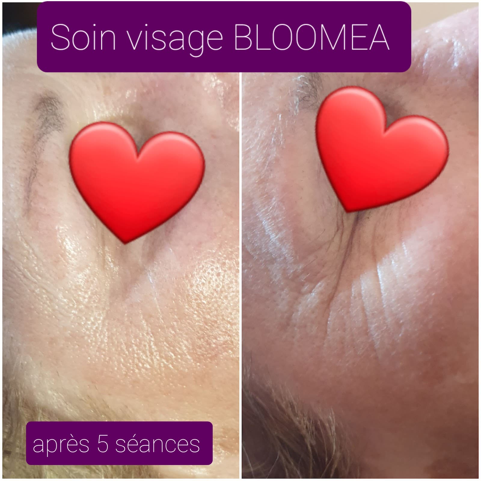 Aperçu avant et après d'un soin visage Bloomea